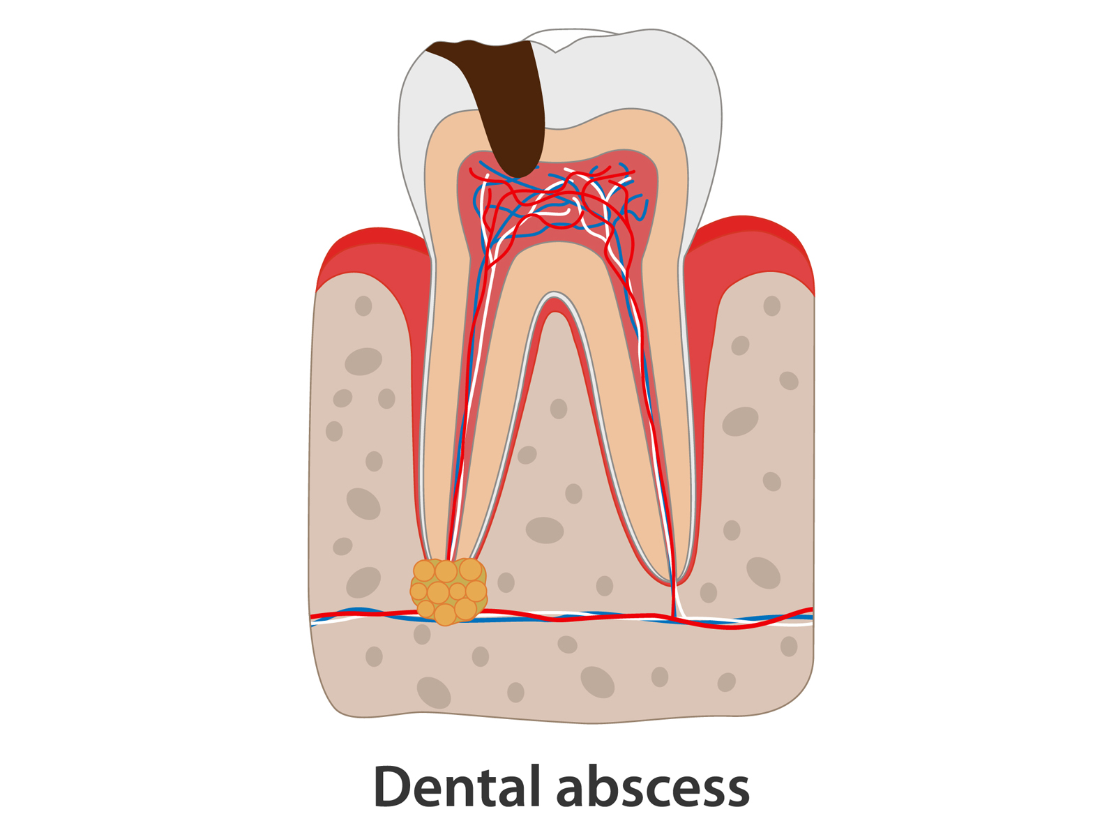 How Can I Get Rid of an Abscessed Tooth at Home?