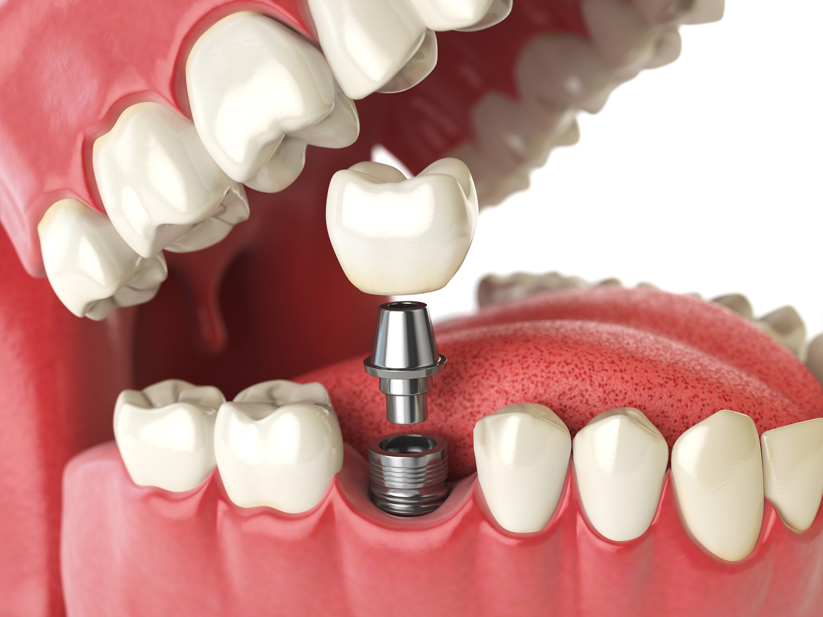 Can dental implants be done in one day?