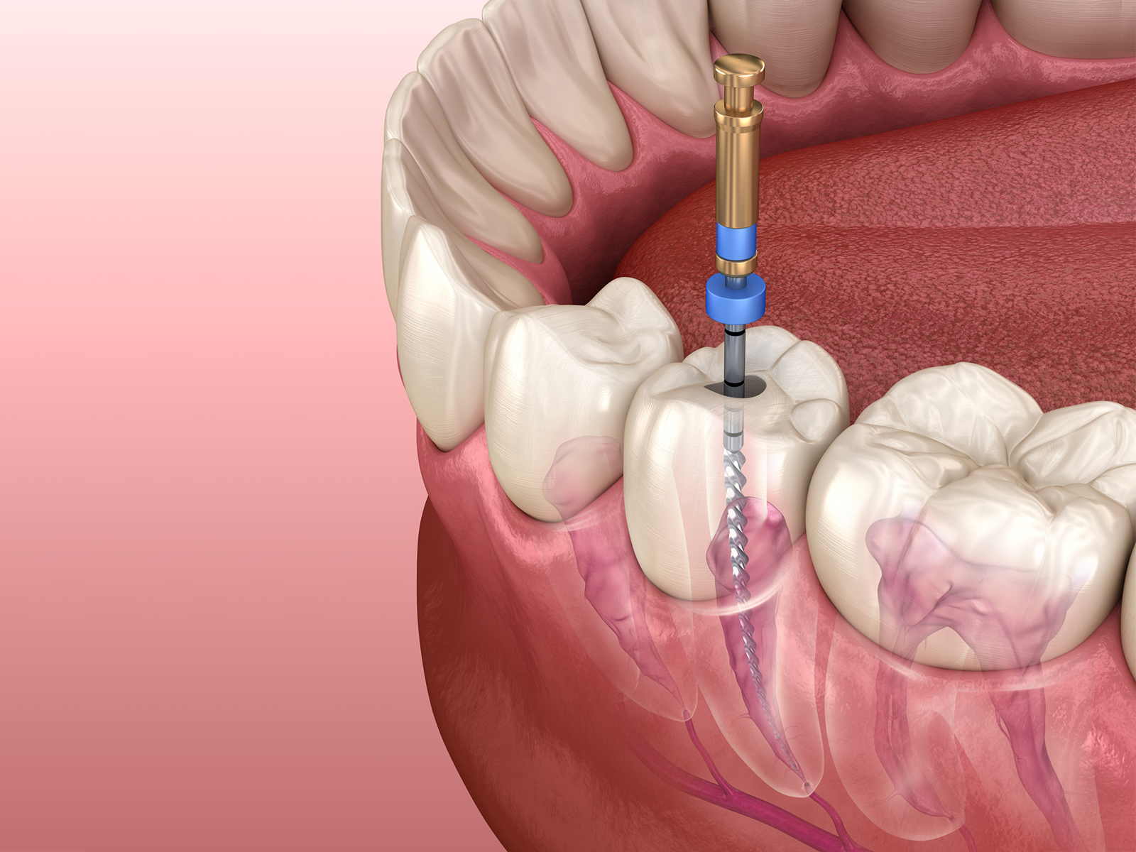 Are You Awake During a Root Canal?