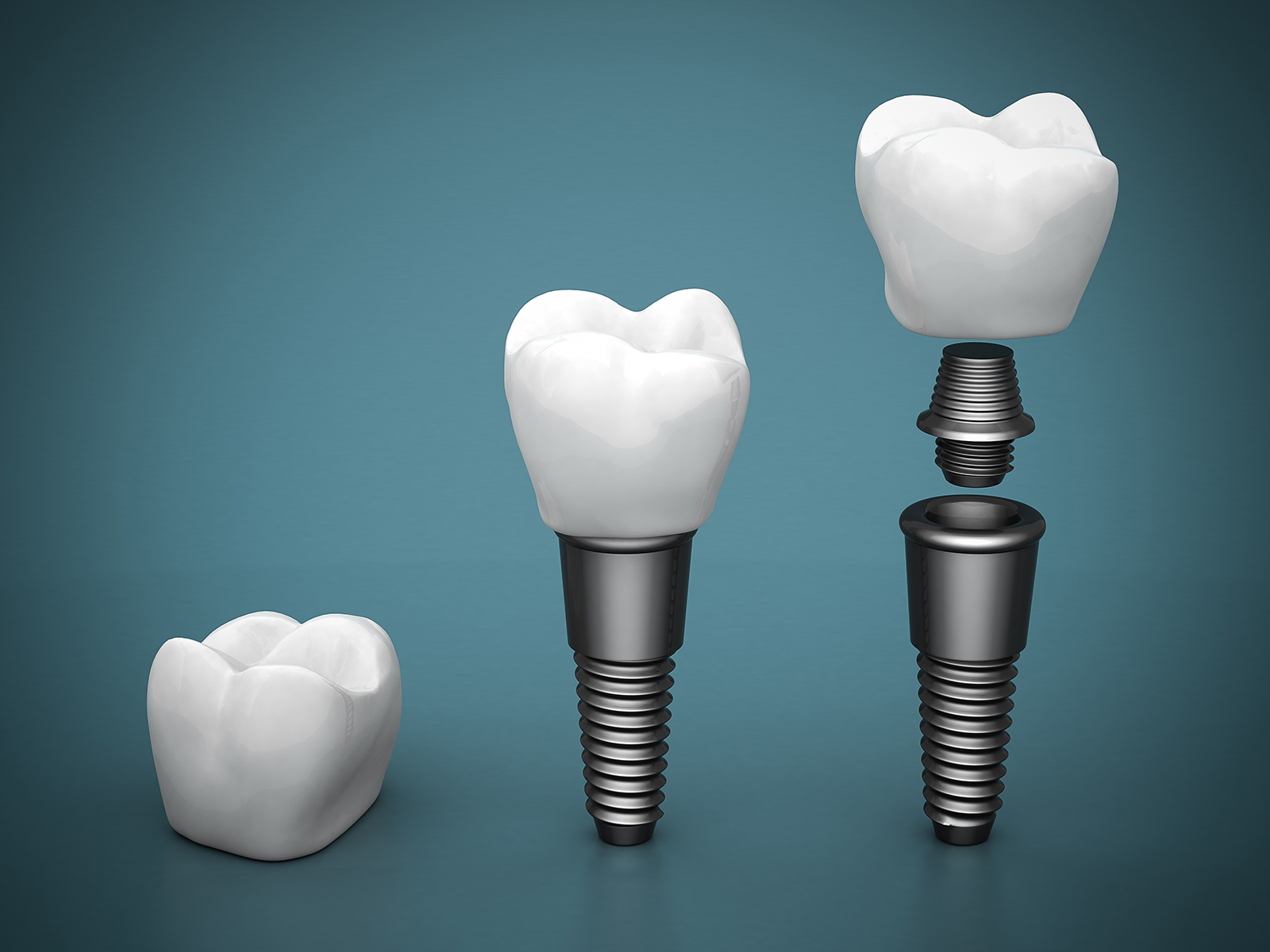 How does a dental abutment work?