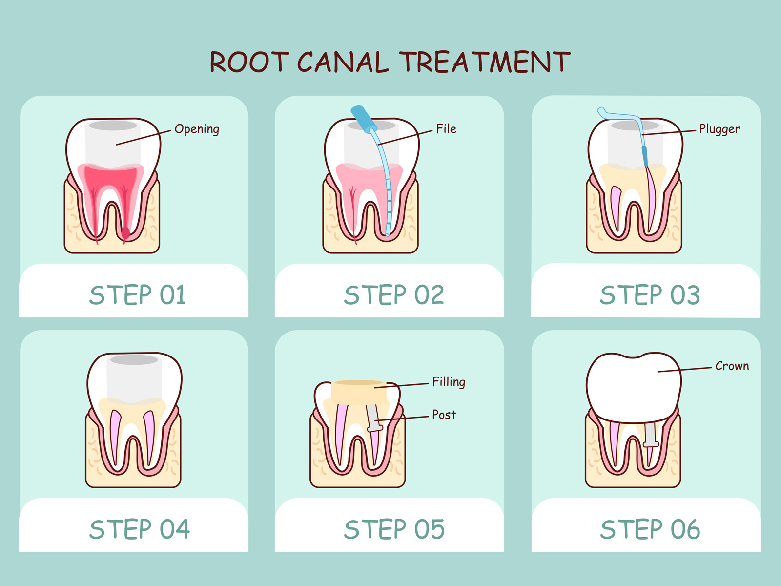 Can You Still Have An Infection After a Root Canal?