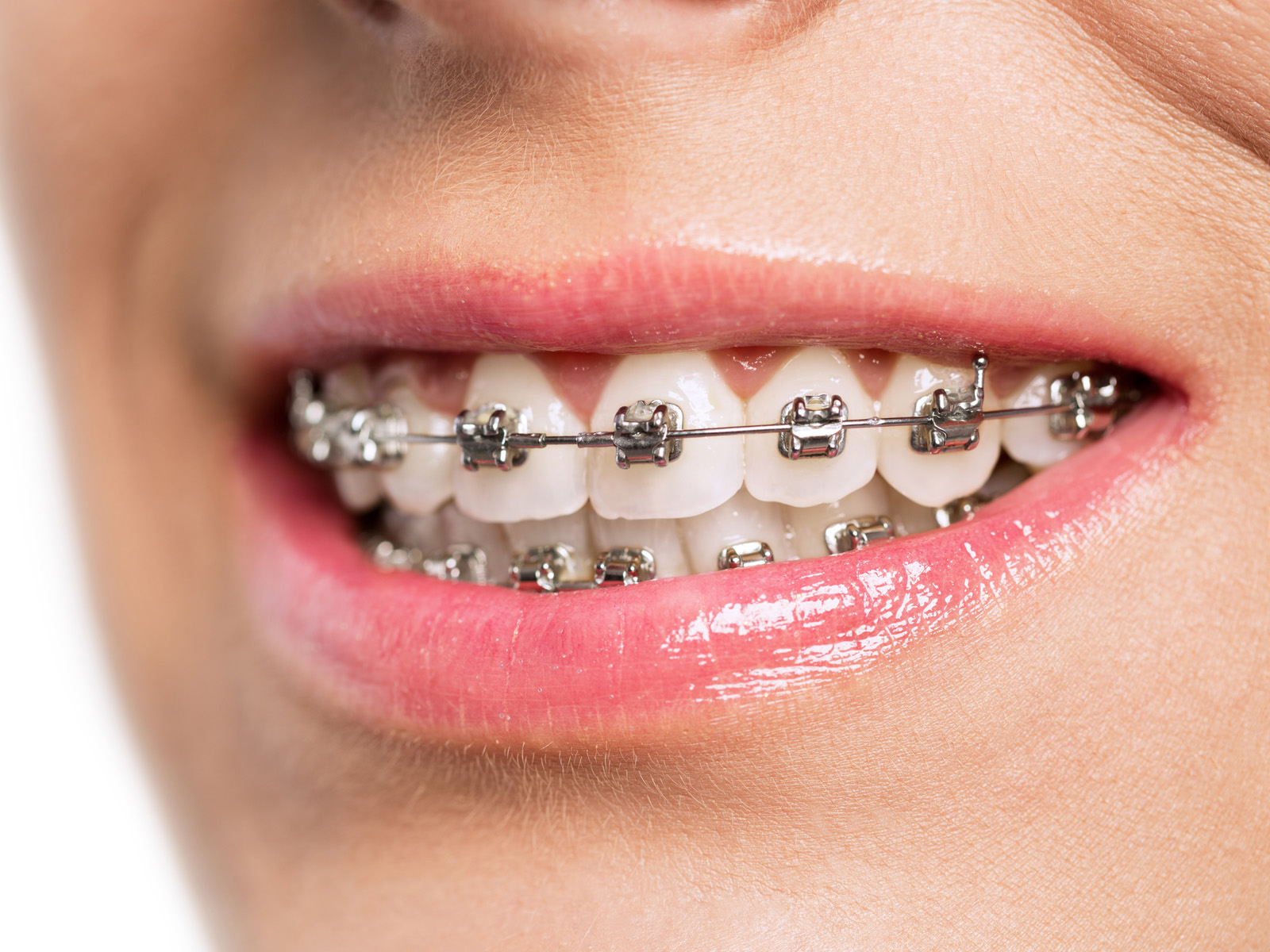Can braces cut your tongue?