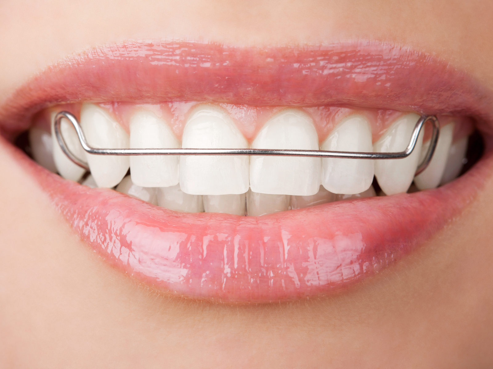 Can a retainer close a small gap?