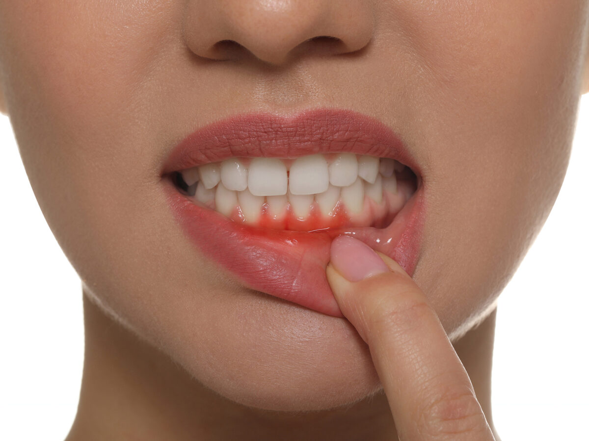 How to get rid of itchy gums?