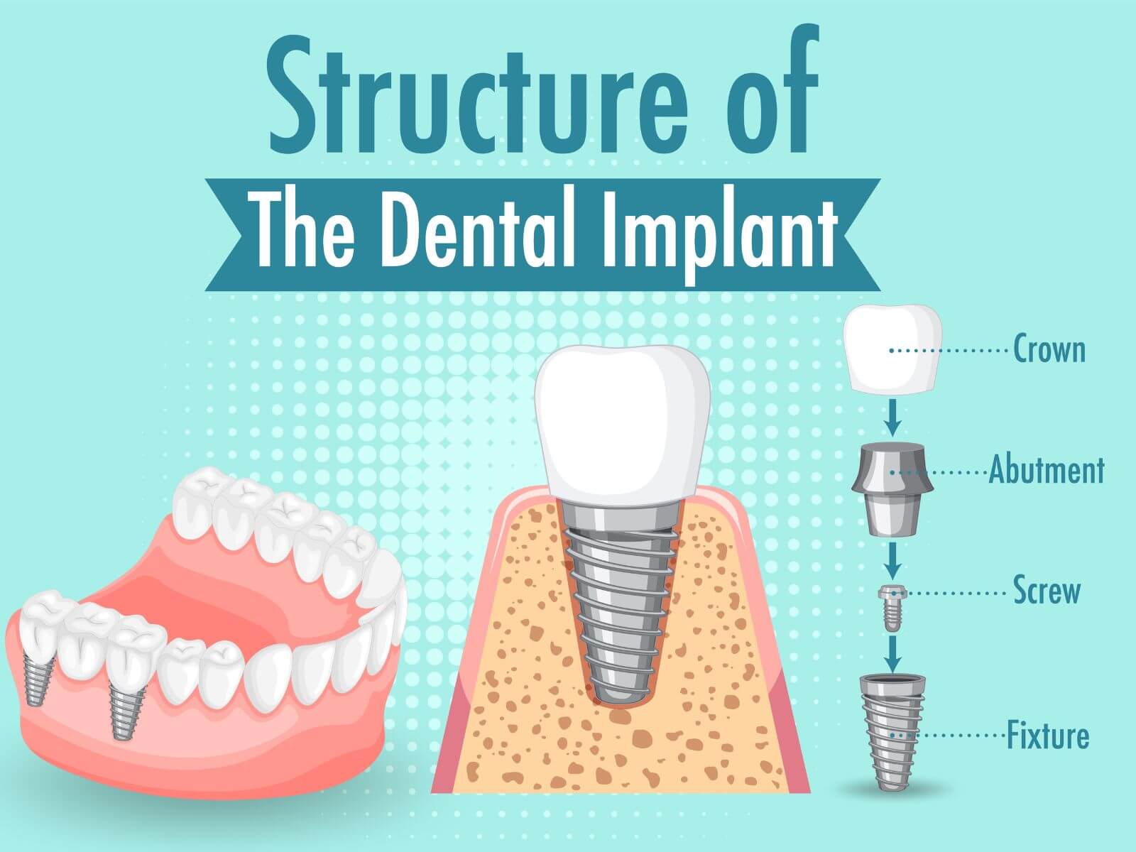 How To Deal With Dental Implant Failure?