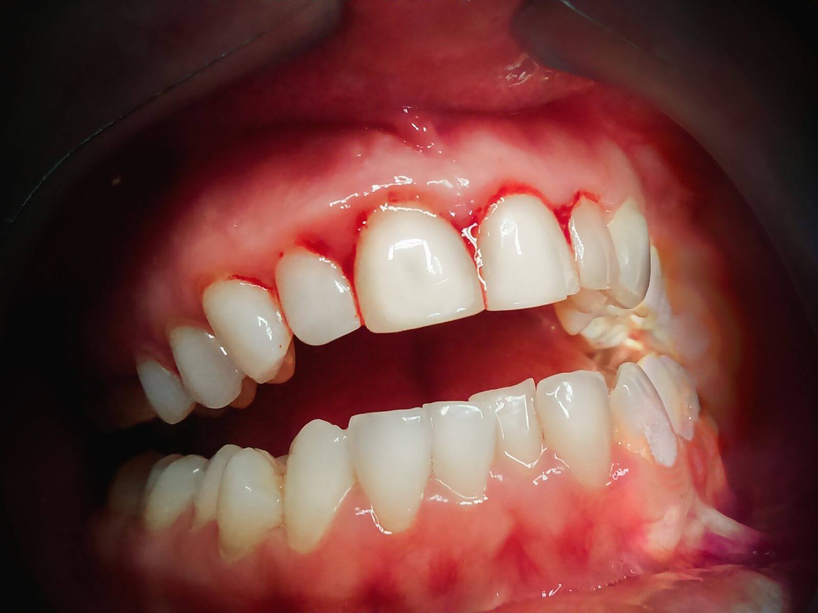 When Should You See A Dentist for Bleeding Gums?