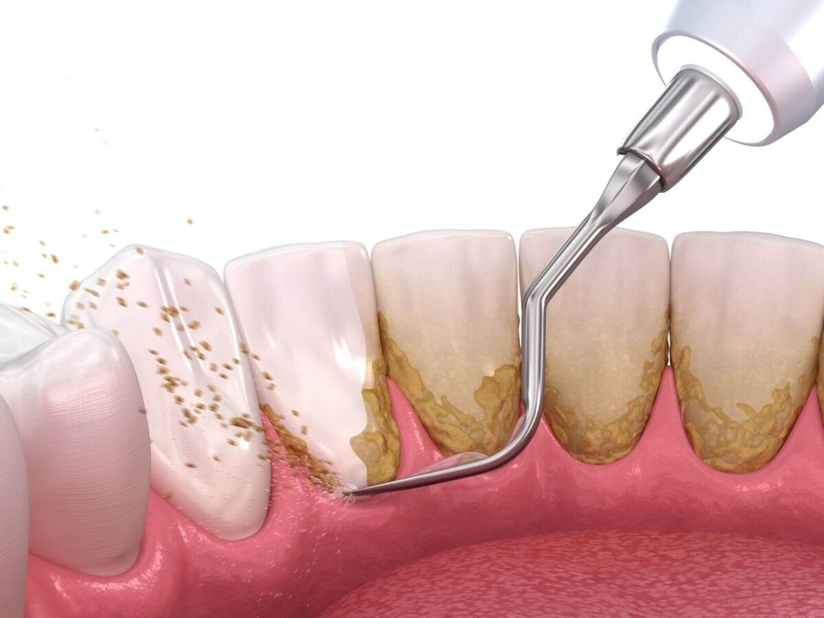 4 Types of Dental Teeth Cleaning