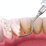 4 Types of Dental Teeth Cleaning