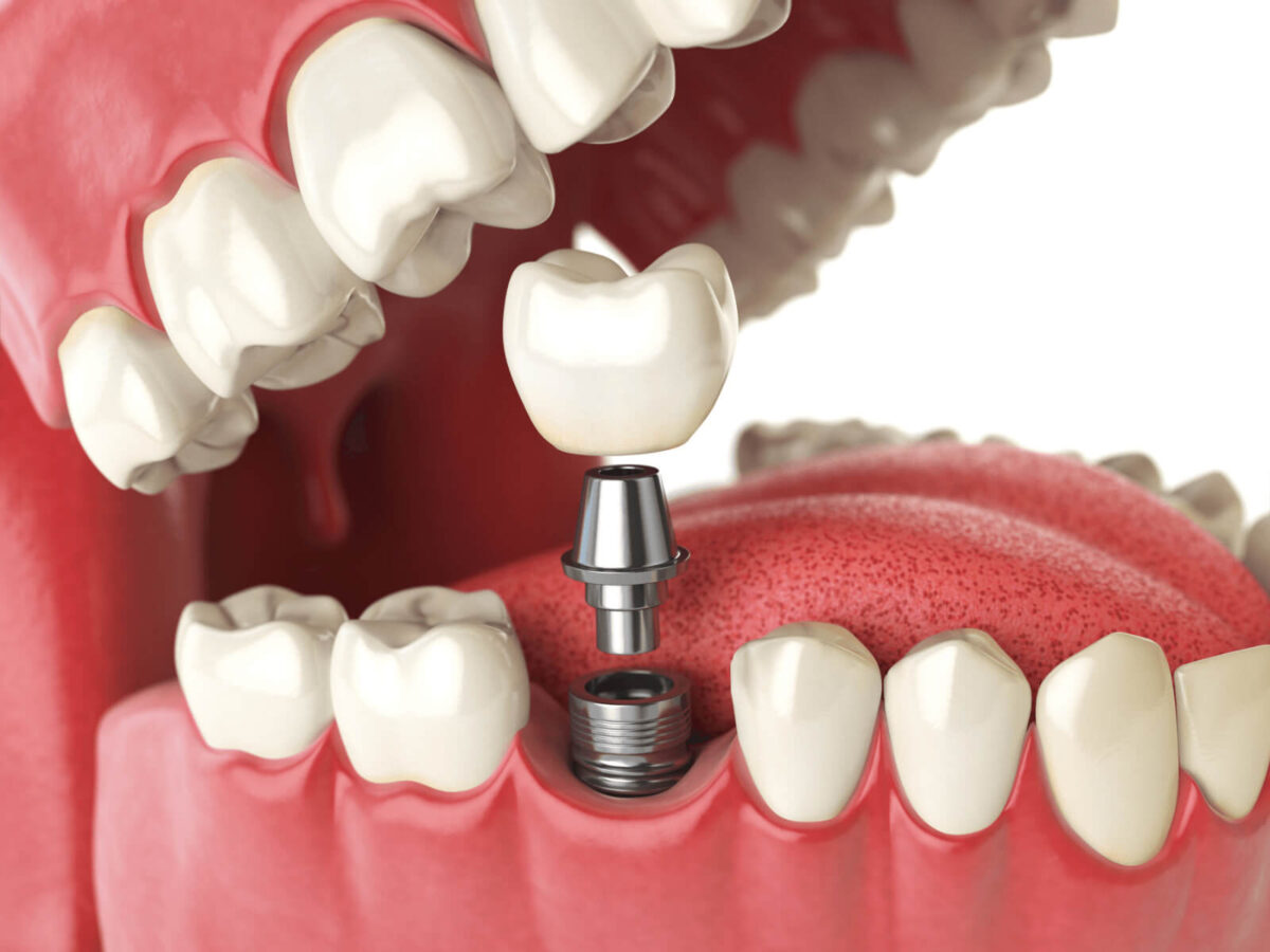 Best Diet For Quick Healing After Dental Implants