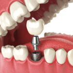Best Diet For Quick Healing After Dental Implants