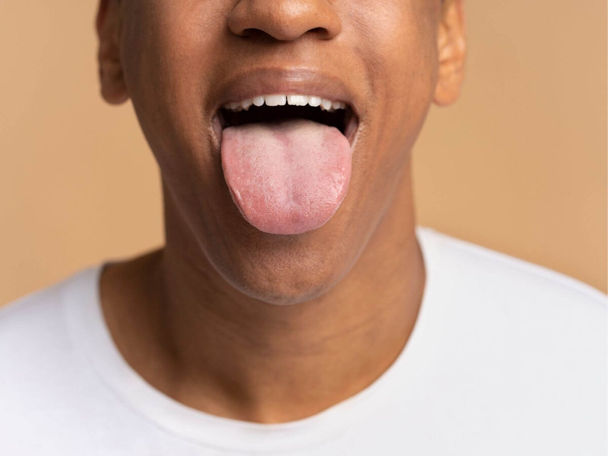 The Link Between Iron Deficiency And Dark Patches on The Tongue