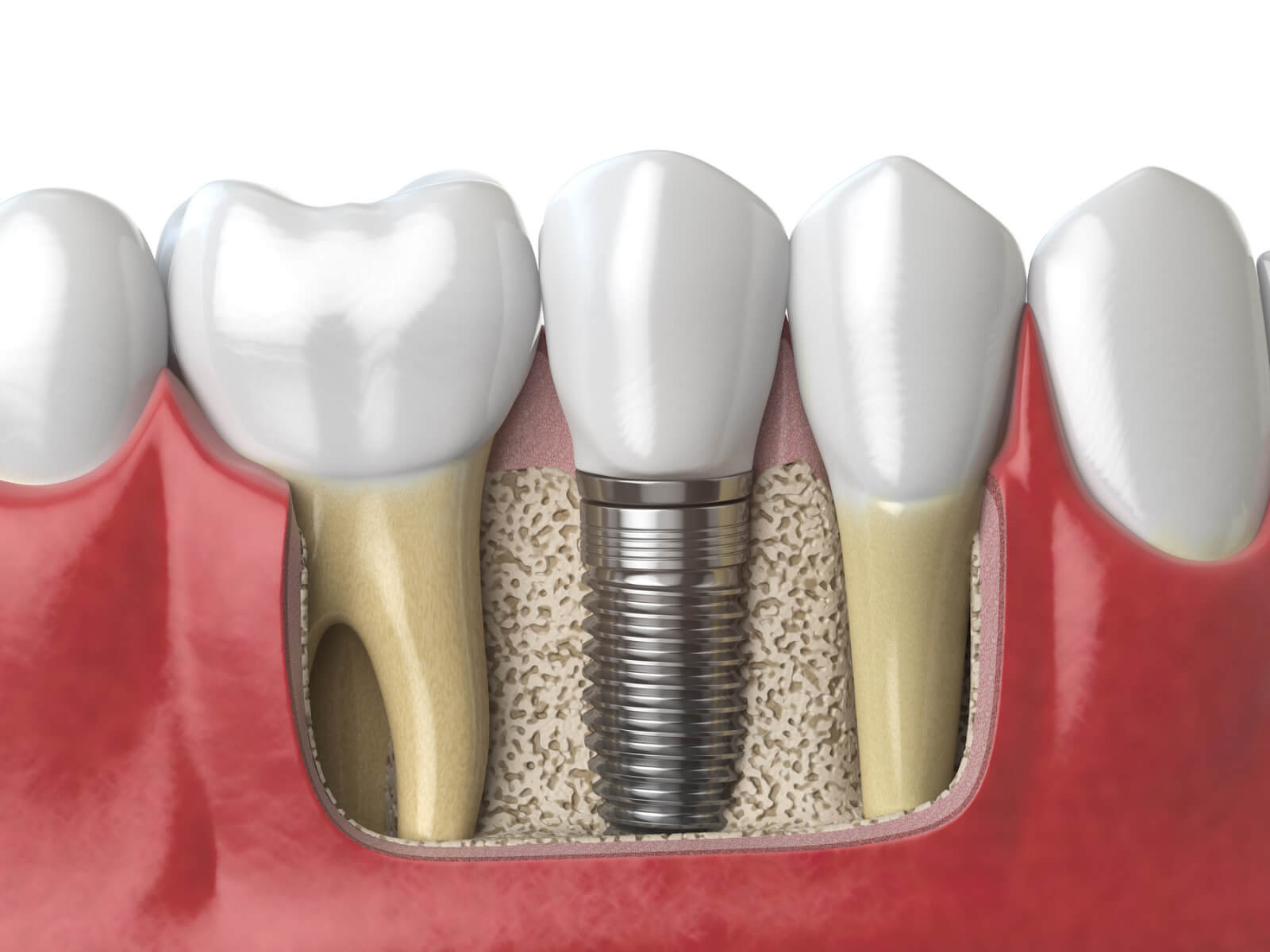 How Dental Implants Can Restore Your Smile After Tooth Extraction