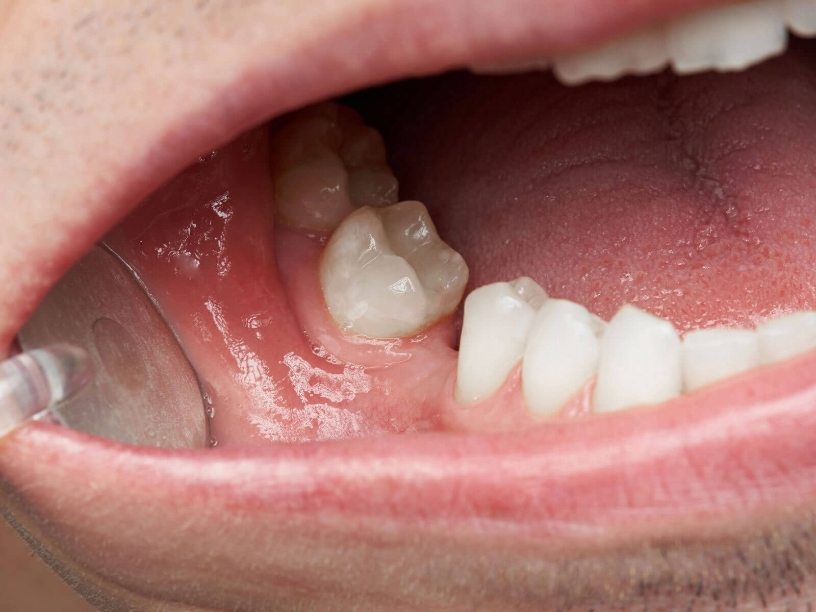 Long-Term Effects Of Missing Teeth On Oral Health