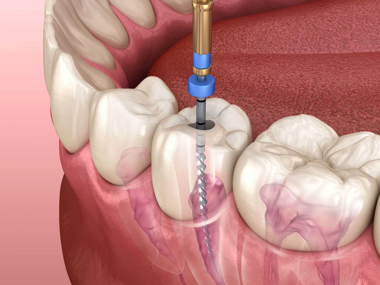 How Much Does a Root Canal Treatment Cost?