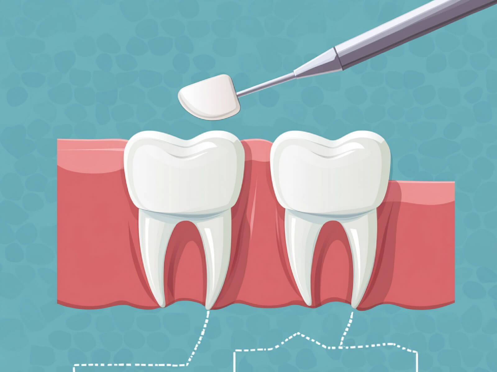 Dental Sealants: Pros, Cons, and Who Should Get Them