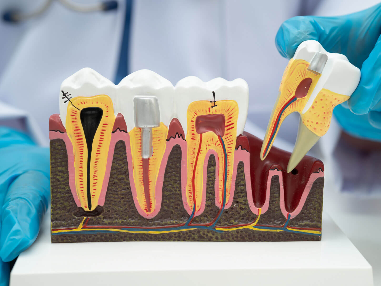 Emergency Root Canal: When You Need It and What to Expect