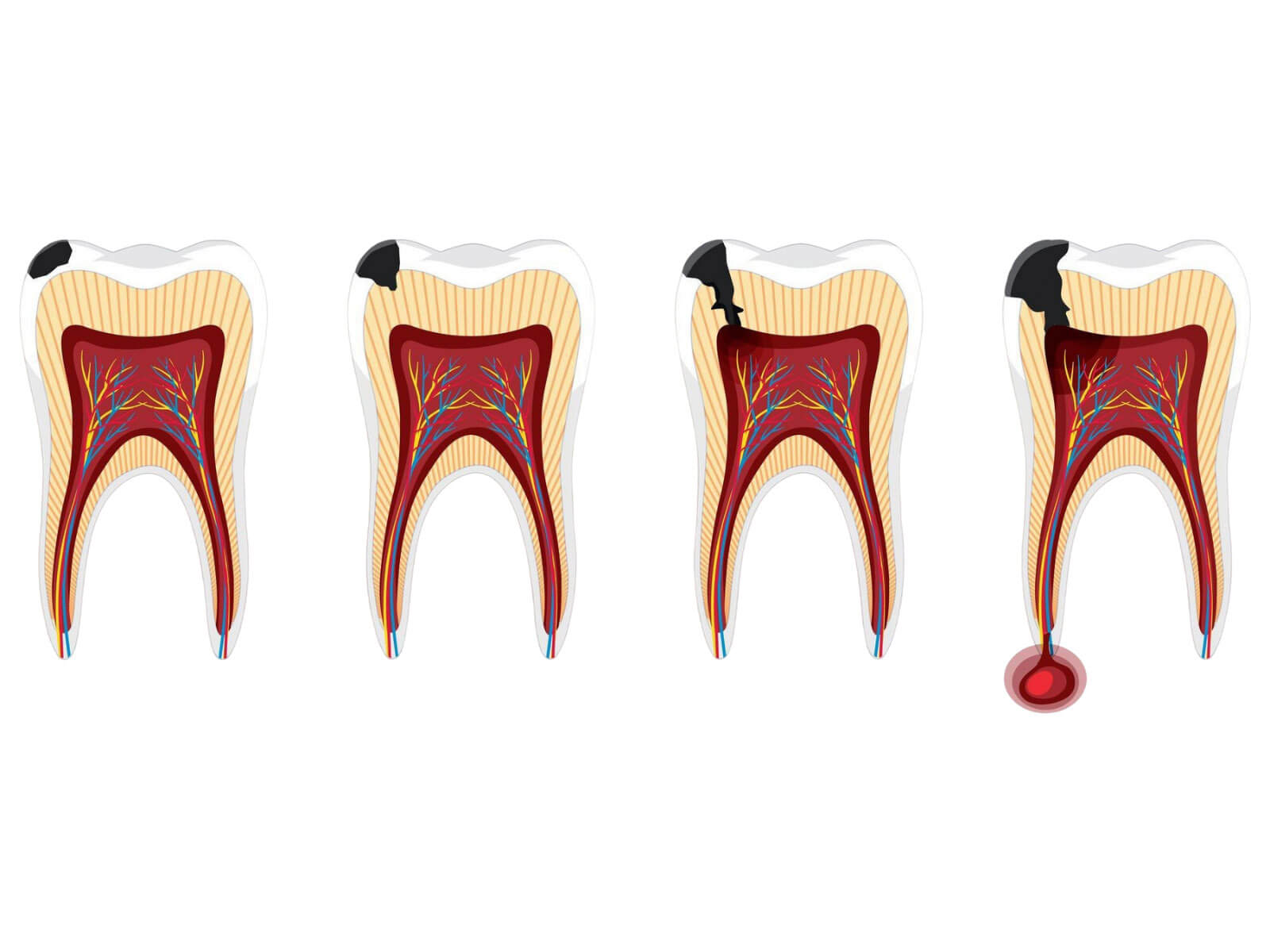 Tooth Decay in Preschoolers: Causes, Signs, and Prevention Tips