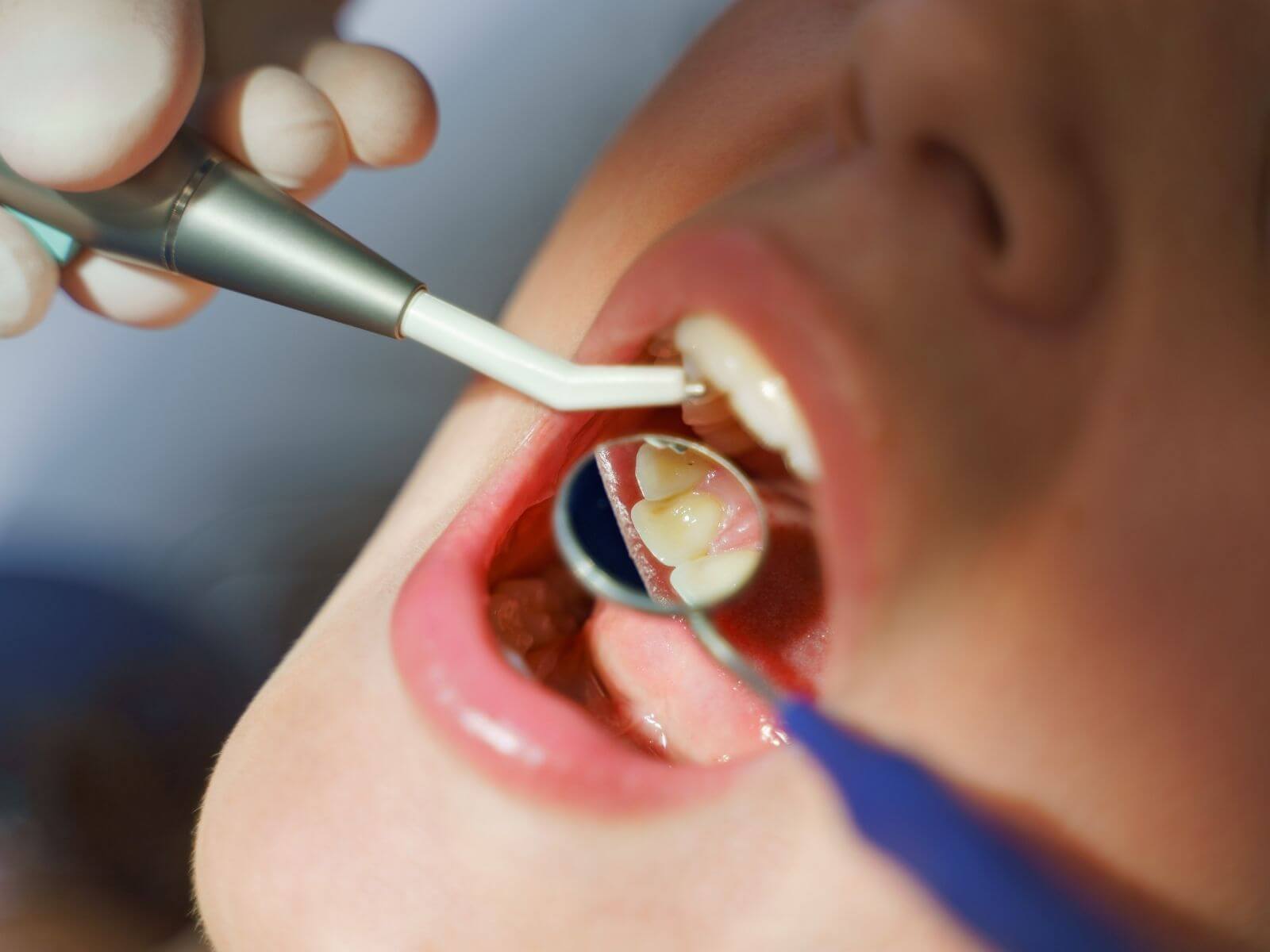 How Much Does a Tooth Filling Cost in the US? By Material and Insurance