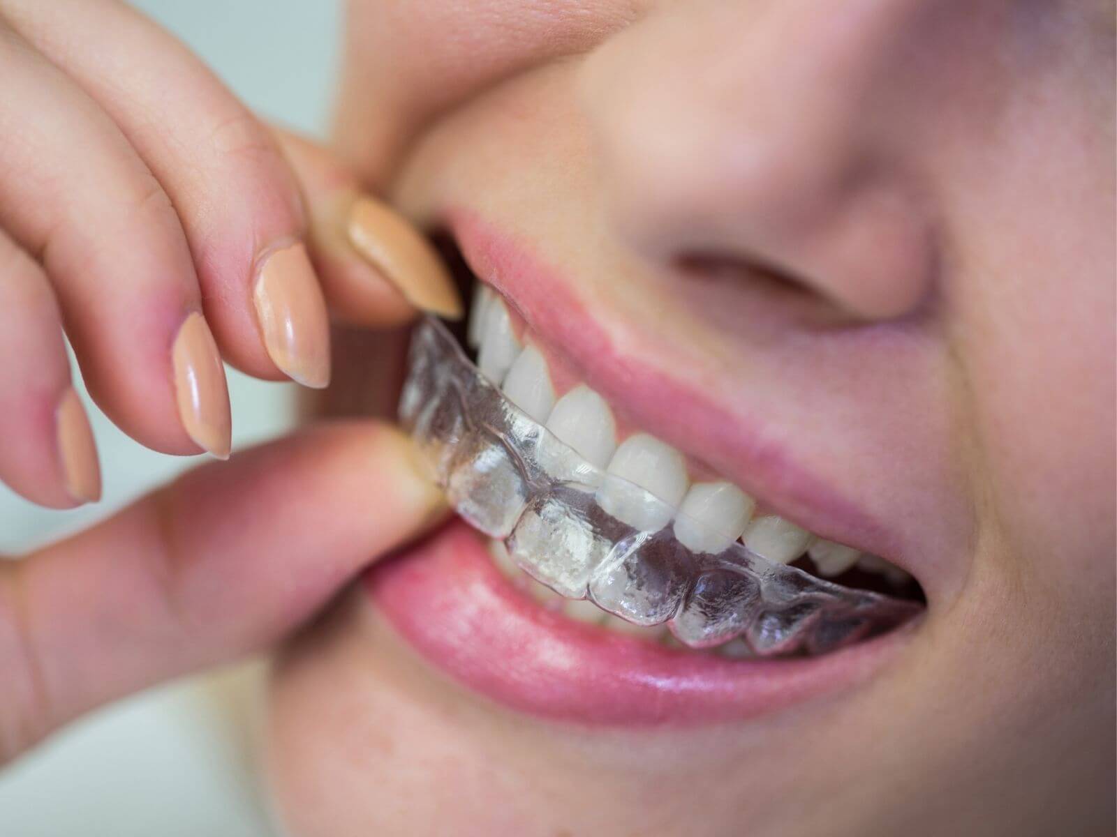 Teeth Straightening Cost: Braces vs. Invisalign vs. Aligners (2026)