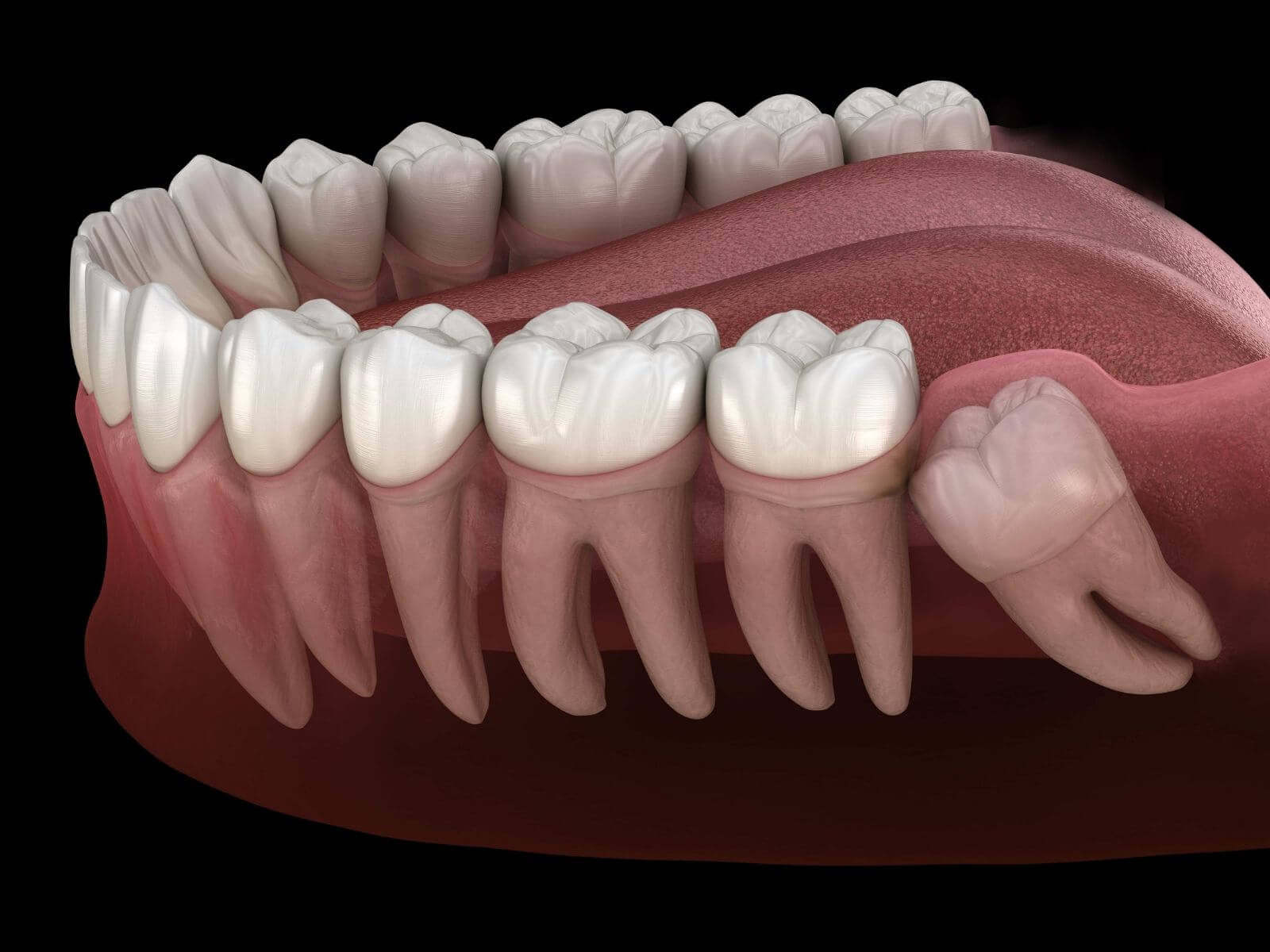 When Do Wisdom Teeth Come In? Age, Signs, and Symptoms