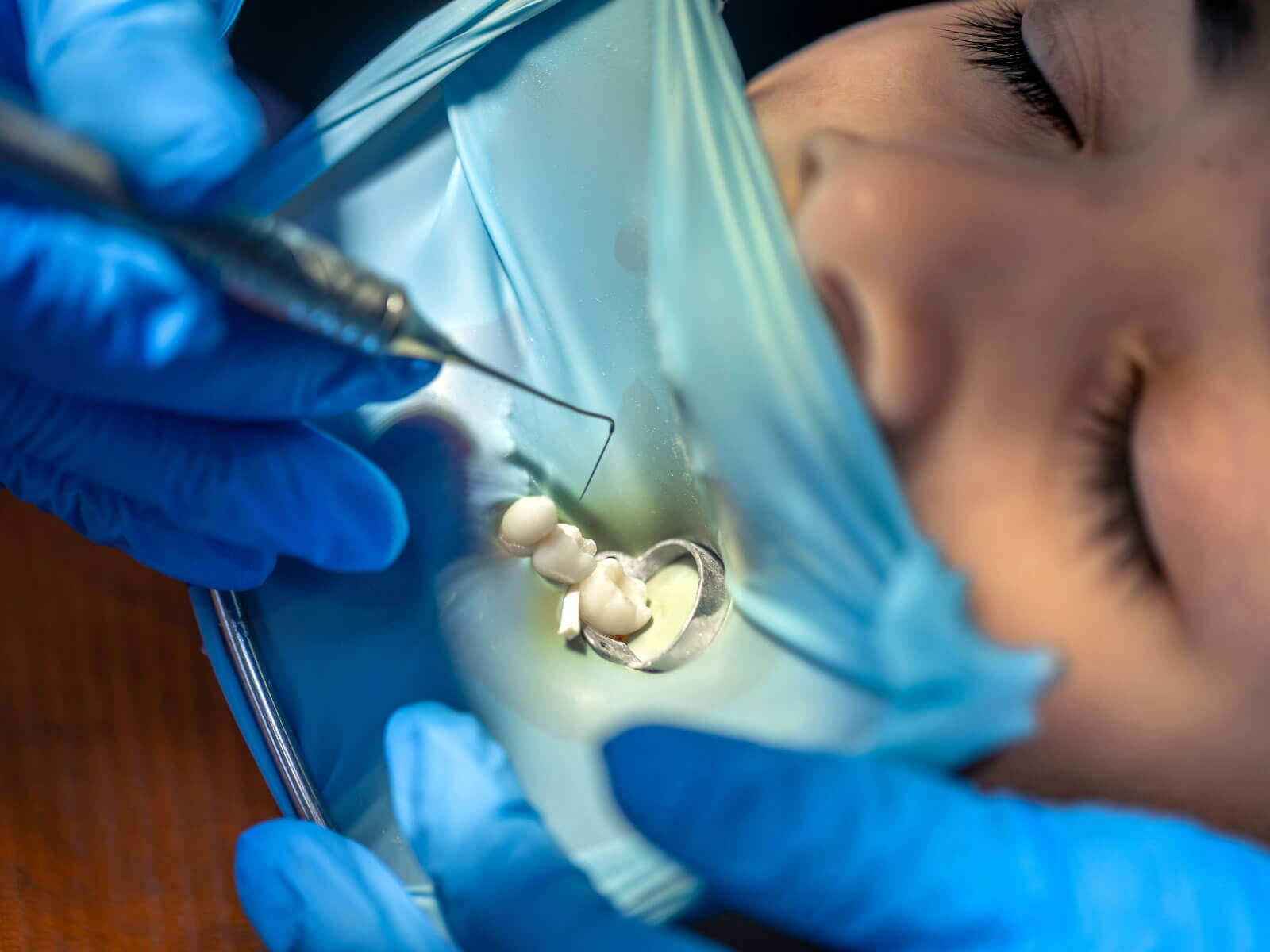 Dental Inlay vs. Filling: Differences in Cost, Procedure, and When Each Is Right for You